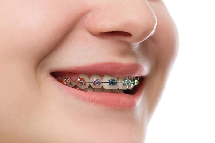 flaviacury-aparelho-metalico-fixo