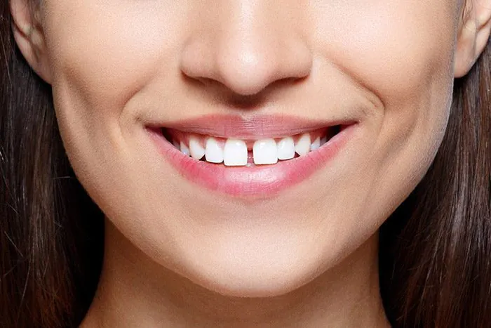 flaviacury-cirurgia-freio-labial