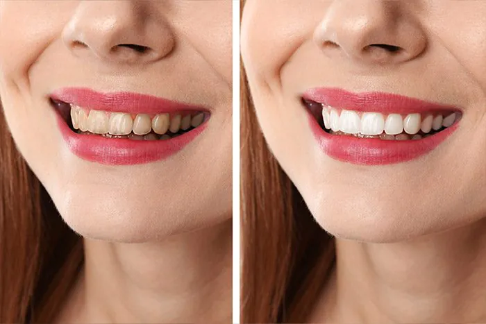 flaviacury-clareamento-dental