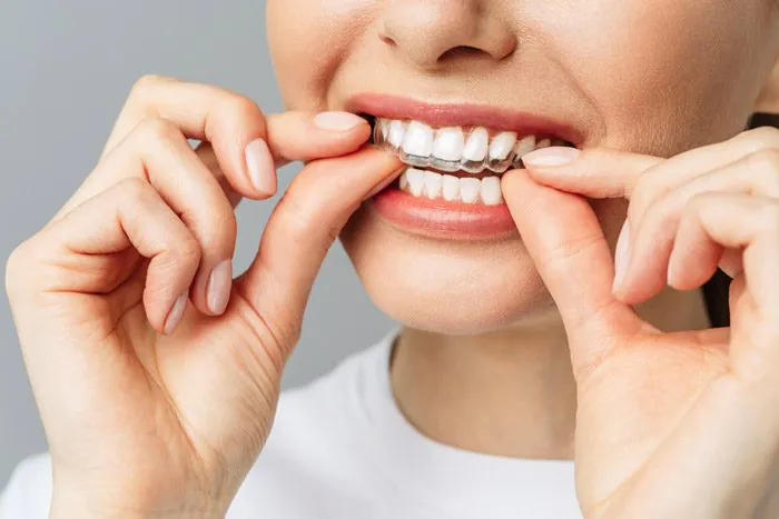 flaviacury-invisalign-2